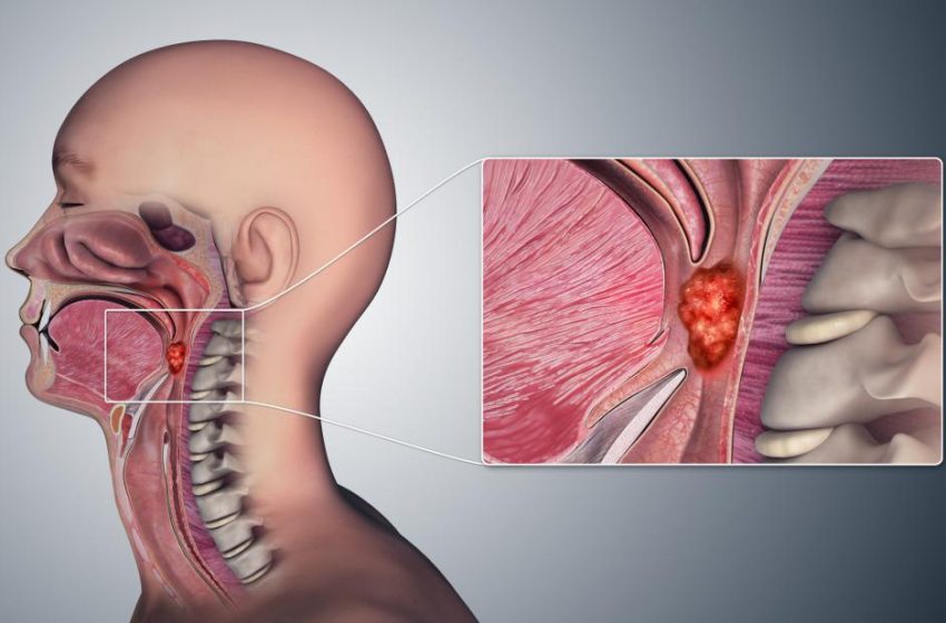  HOW CAN YOU DETECT THROAT CANCER AT HOME