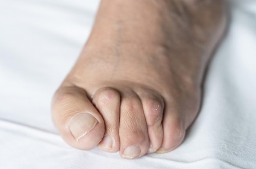  How Long Does It Take to Recover After Bunion Surgery?