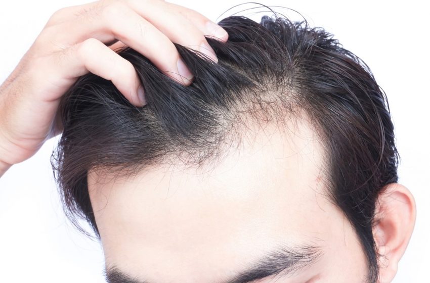  Why should we go for Hair Loss Treatment