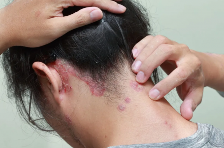 The psoriasis disease can affect the scalp and face