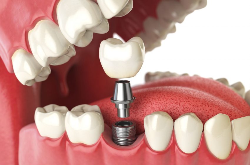  Is it possible to get headaches from dental implants?