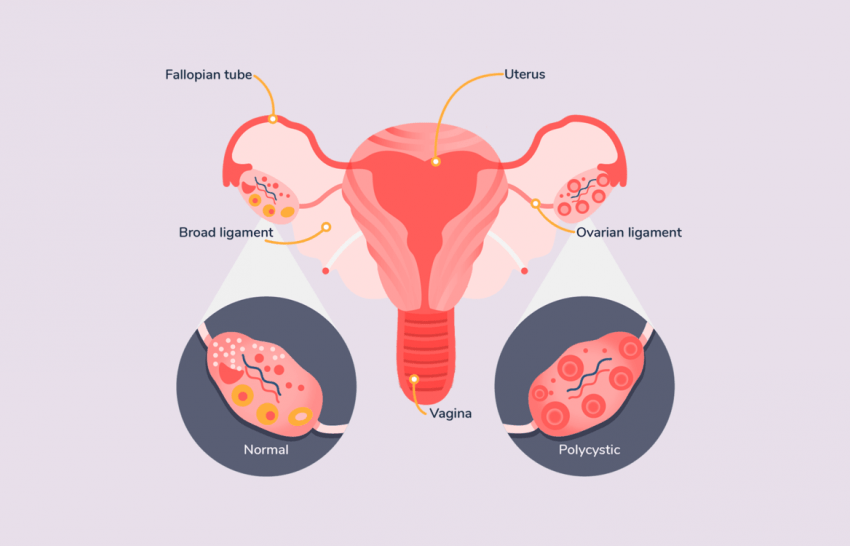  Are  Bilateral Polycystic Ovaries and PCOS the same?