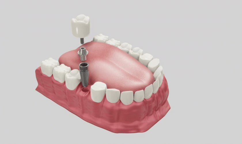  Should You Get Dentures or Dental Implants in Willowbrook?