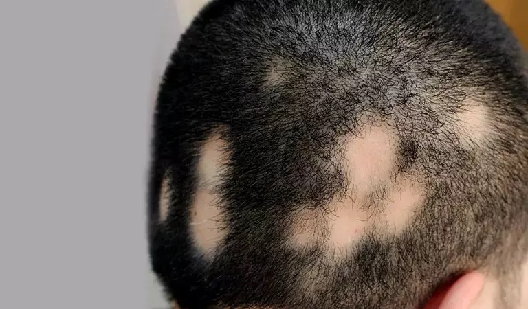 How to stop Alopecia from spreading