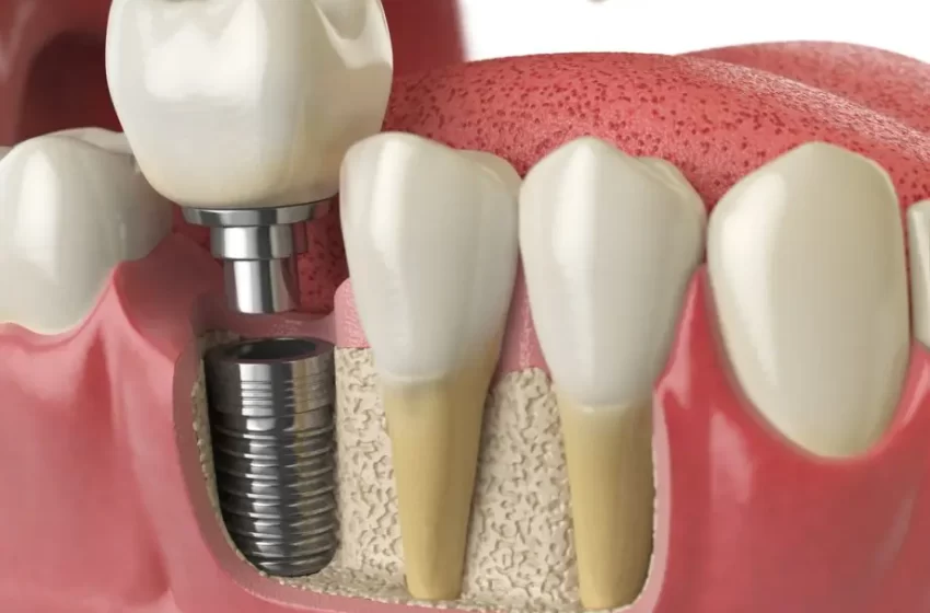  A Step-By-Step Guide To Dental Implant Care