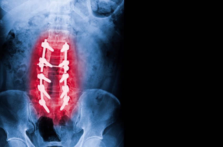  The Science of Surface Engineering: Dr. Larry Davidson Discusses Texture’s Impact on Spinal Fusion