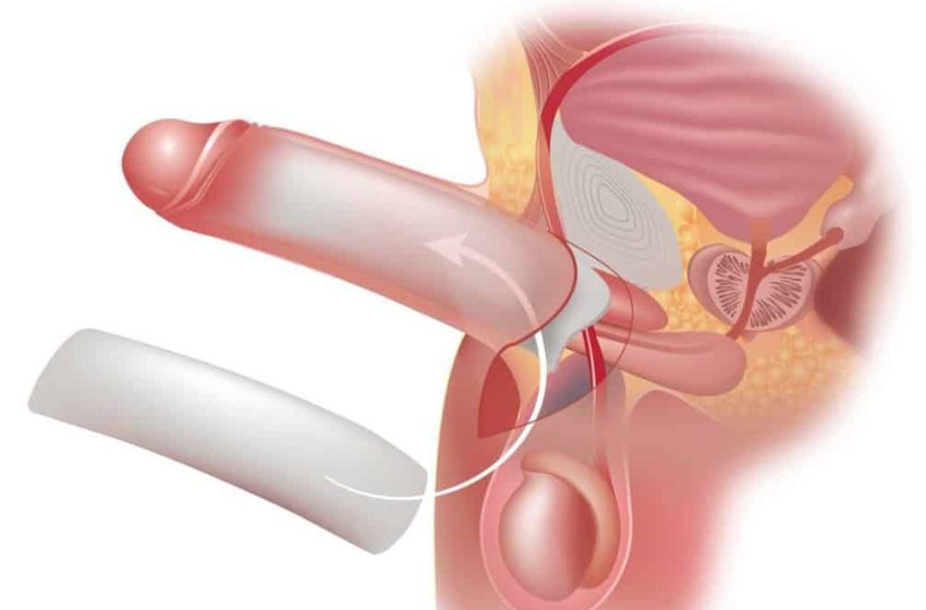 Penis Enlargement Treatments
