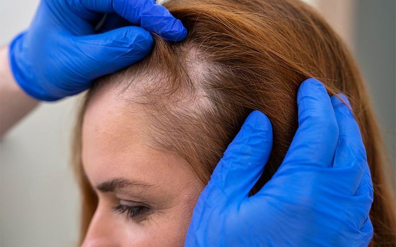  3 Signs of Balding and Hair Treatments Available in Singapore